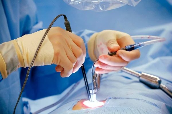Surgical Procedure for Piles
