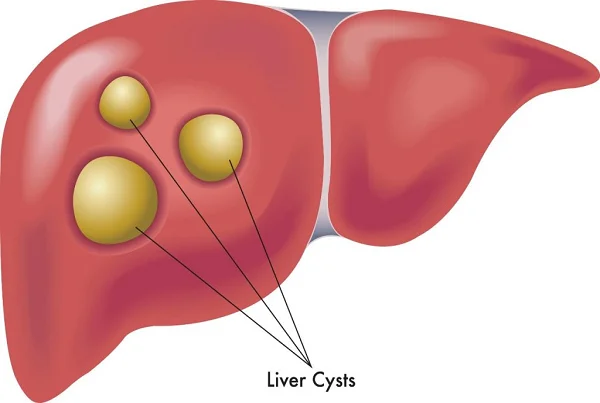 Liver Cysts