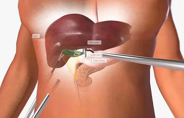 Laparoscopic Cholecystectomy